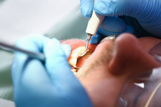 Best Emergency Treatment for Dental Infections or Abscesses in Foley, AL