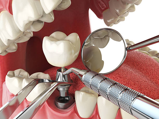 Best Emergency Denture Repair in Foley, AL